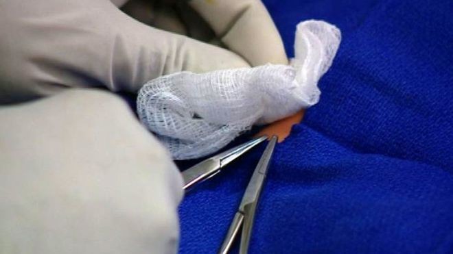 Bayi Lima Bulan Meninggal Usai Dikhitan