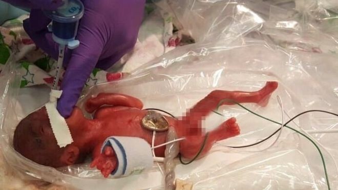 Lahir Seberat Buah Apel, Ini Bayi Termungil di Dunia