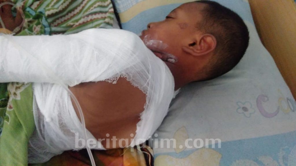 Bermain Petasan, Bocah 9 Tahun Terbakar