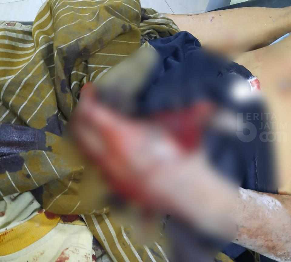 2 Jempol Putus akibat Petasan Meledak, BPJS Tak Tanggung Biaya Pengobatan