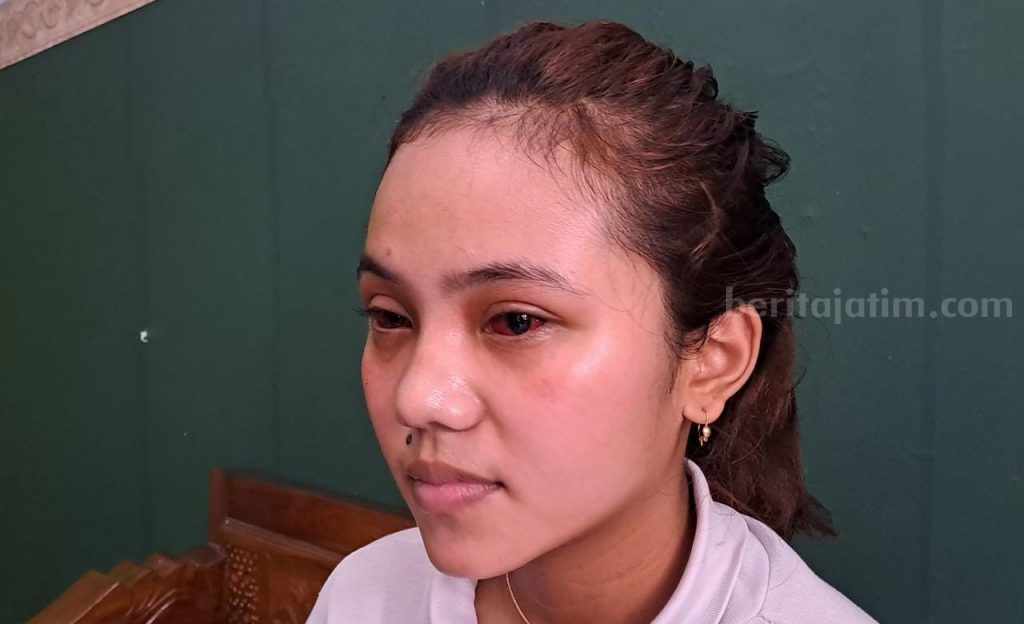 Sebagian Besar Korban Tragedi Kanjuruhan Alami Mata Merah Akibat Gas Air Mata