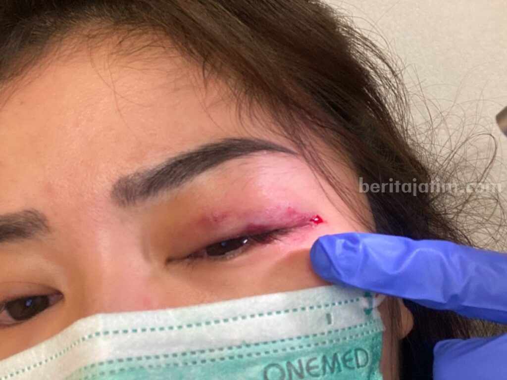 Sepupu anak Hotman Paris, Dessy saat menunjukan luka bekas KDRT oleh suaminya HA. (Foto/ist)
