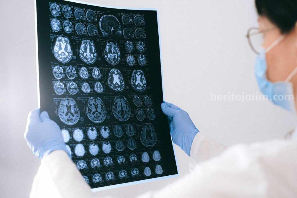David Latumahina Korban Penganiayaan Didiagnosis Diffuse Axonal Injury, Apa Itu? Ilustrasi CT-scan brain injury.