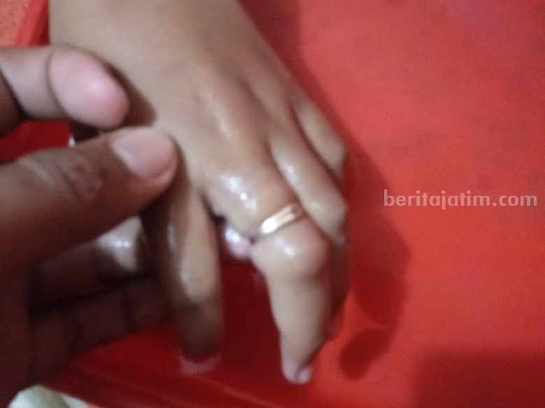 Jari seorang anak di Jombang bengkak akibat cincin yang dipakai tak bisa dilepas