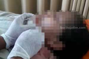 Mahasiswi Sampang Terjerat Benang Layang Layang Hingga Muka Robek Inisial NH saat menjalani perawatan medis usai terjarat benang layang-layang (Foto: Zamachsari/beritajatim.com)