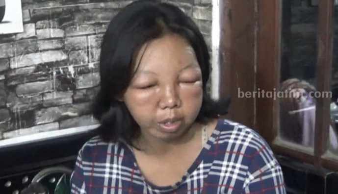 Ibu hamil di Desa Mancilan Mojoagung wajahnya bengkak akibat disengat tawon vespa