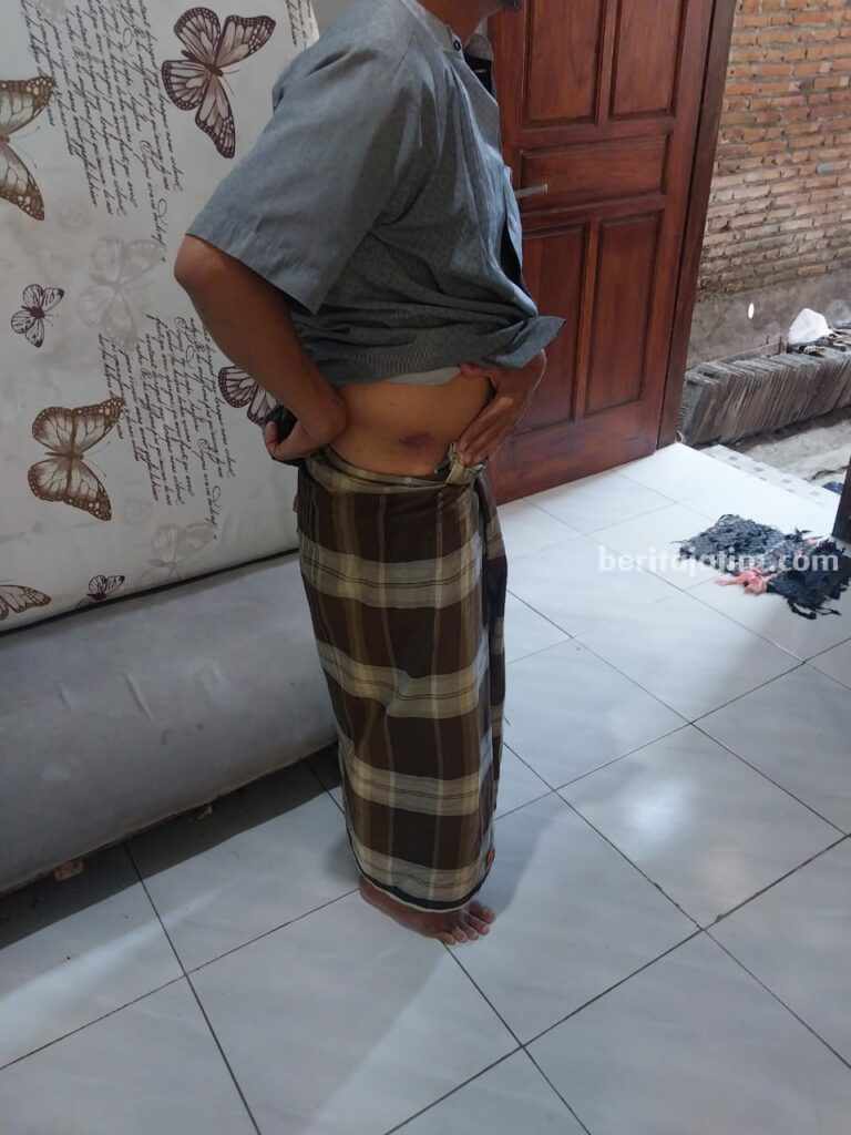 Guru SMPN 5 Singosari Malang Jadi Korban Penganiayaan Kepala Sekolah Guru SMPN 5 Satu Atap Singosari, menunjukkan luka bekas penganiayaan.