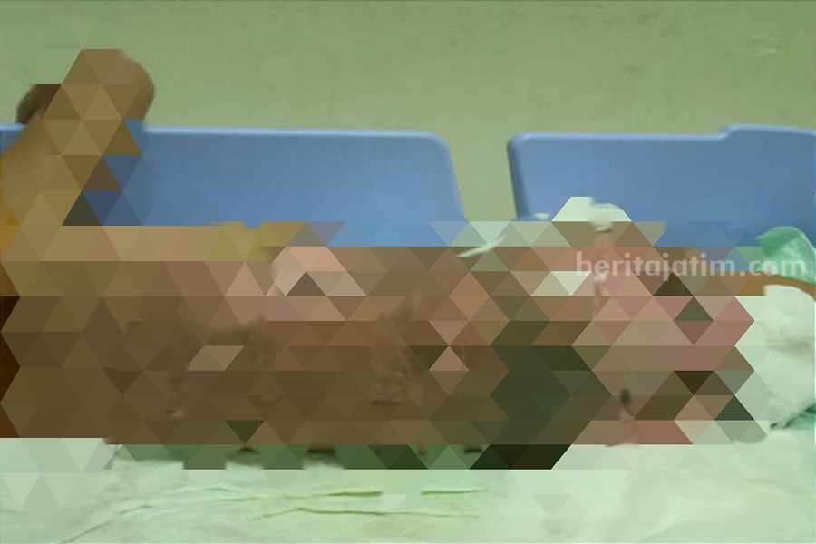 Kulit tubuh balita Ramadani melepuh usai tercebur panci berisi kuah sayuran panas. (Foto/Istimewa)