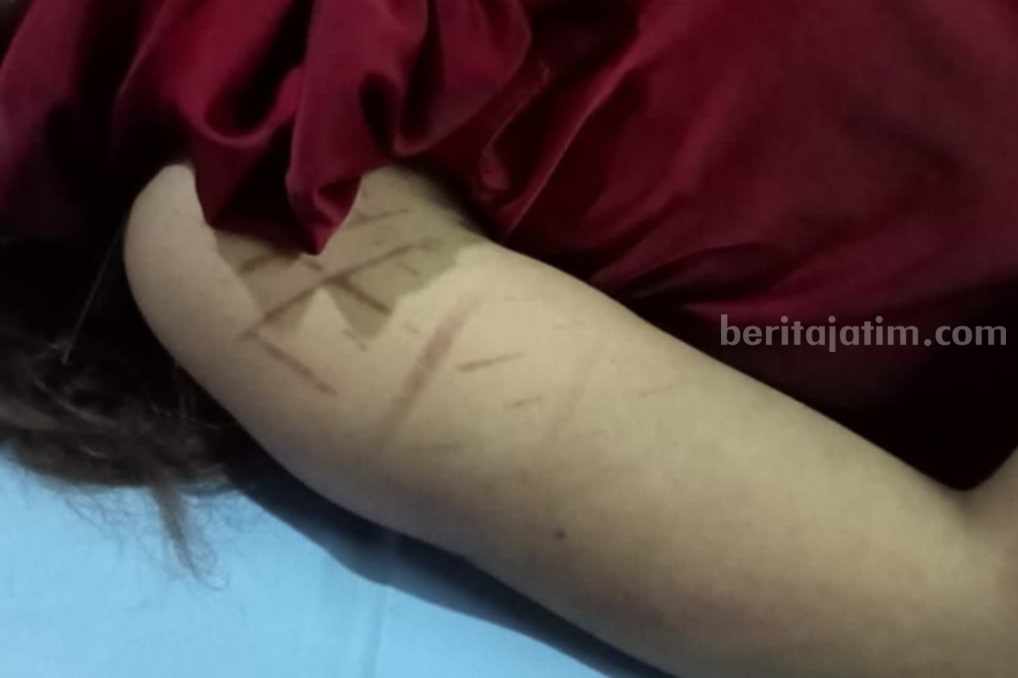 Bekas ban yang ditemukan di tangan kanan Dini Sera saat proses otopsi di kamar jenazah RSUD dr. Soetomo.