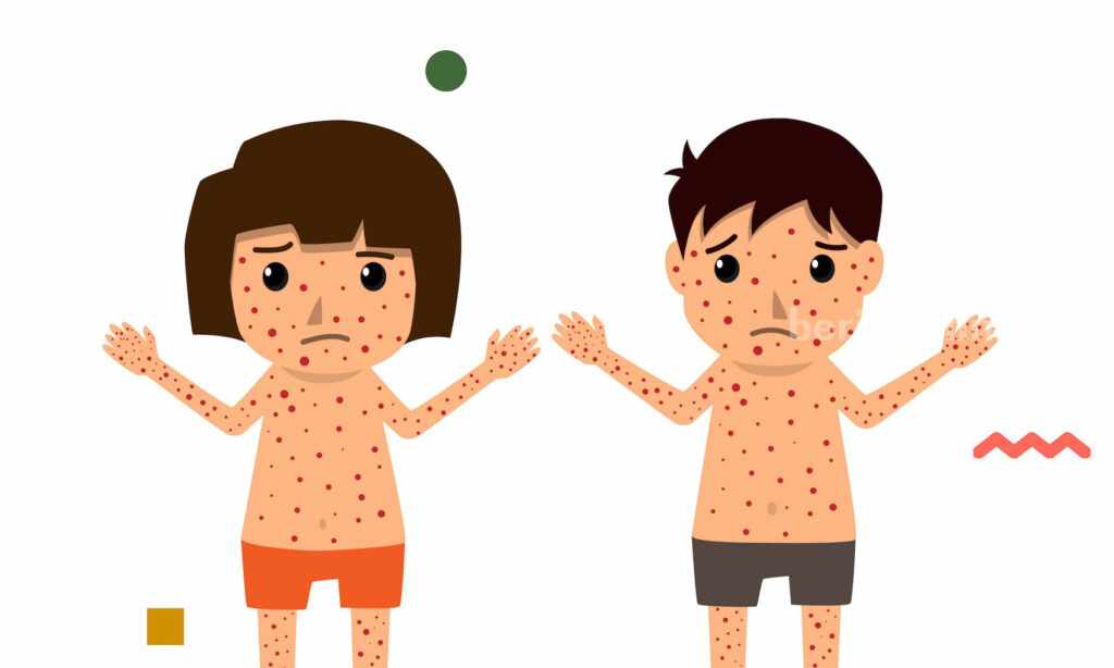 Banyak Siswa di DIY Terserang Cacar Air ilustrasi Cacar Air