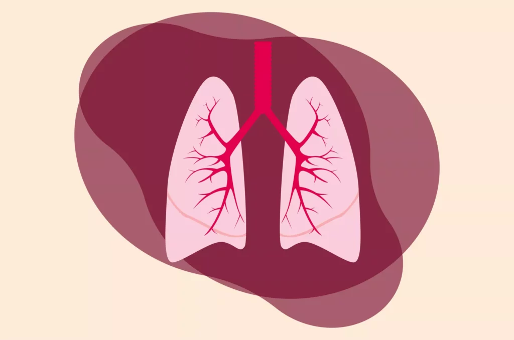 Ilustrasi pneumonia.