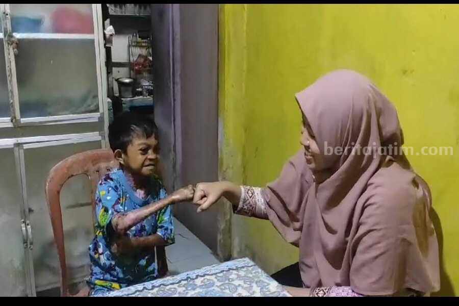 Remaja Penderita Kulit Melepuh Dapat Perhatian Mensos Risma Foto Berita Jatim