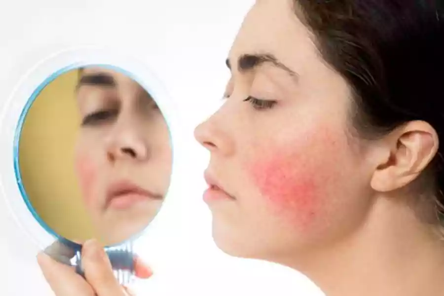 Lebih Kronis dari Jerawat, Rosacea Terjadi di Wajah Malah Diremehkan Foto Berita Jatim