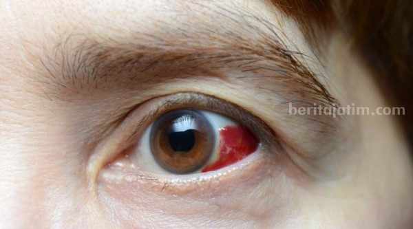 Potret bercak merah pada mata atau perdarahan subkonjungtiva. (Sumber foto: kibrispdr.org)