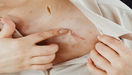 Begini Agar Bekas Luka Cepat Hilang, Bahan Mudah Didapatkan Begini Agar Bekas Luka Cepat Hilang, Bahan Mudah Didapatkan