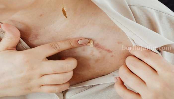 Begini Agar Bekas Luka Cepat Hilang, Bahan Mudah Didapatkan