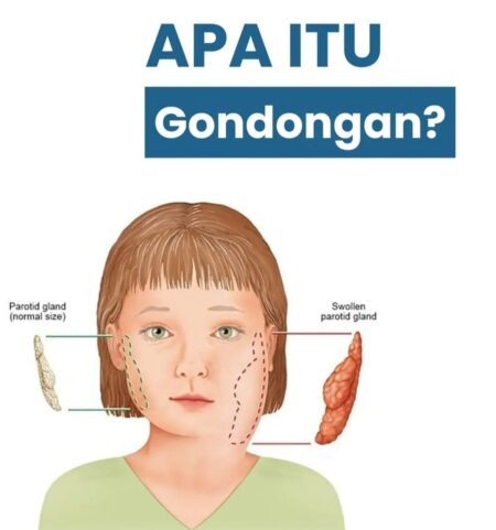 Awas Berbahaya! Kasus Penyakit Gondongan di DIY Melonjak, Bagaimana di Jatim? Ilustrasi Gondongan (Akun Instagram @klinik_daaruttauhid)