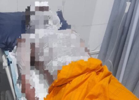 Asyik Bermain Petasan, Pemuda Asal Driyorejo Gresik Alami Luka Bakar Foto BeritaJatim.com
